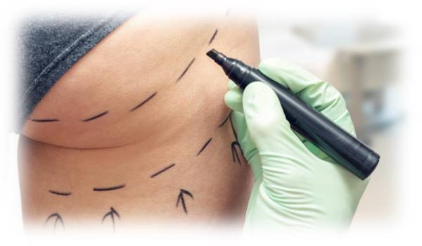 Bioestimuladores de colágeno corporal